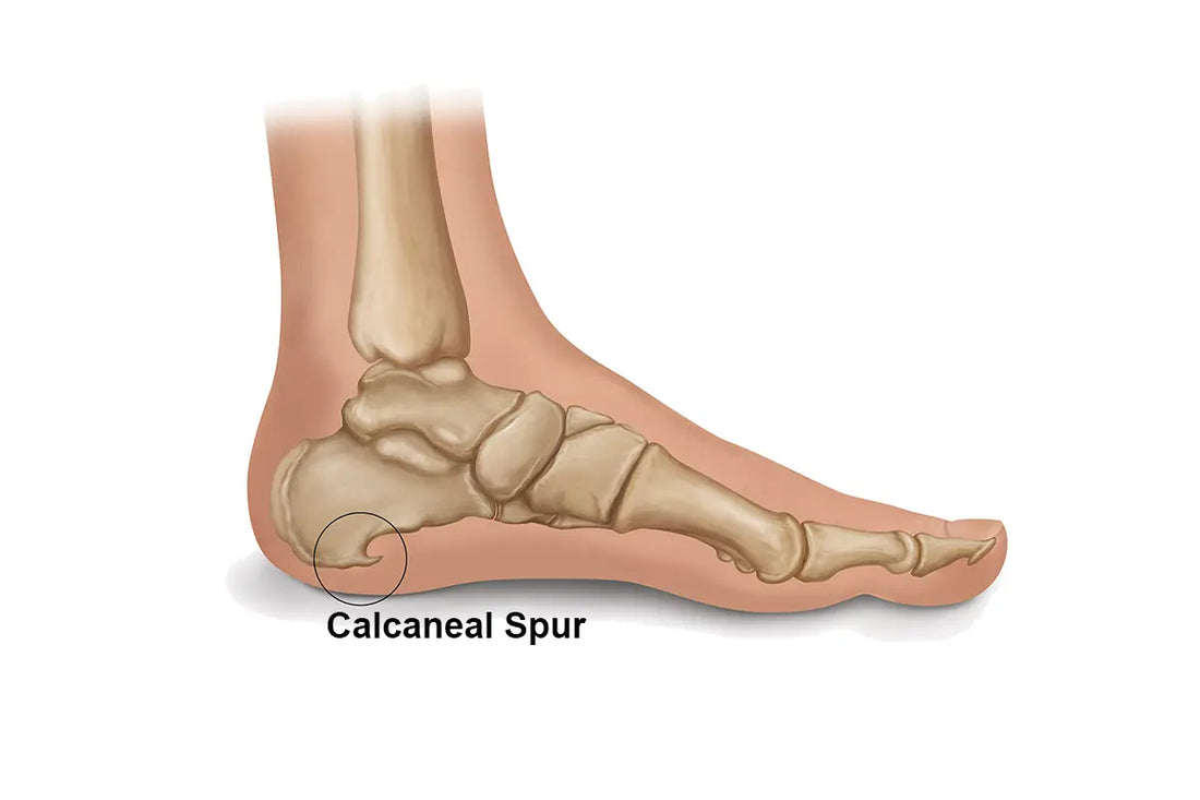 Coconut Oil eases Calcaneal Spur pain