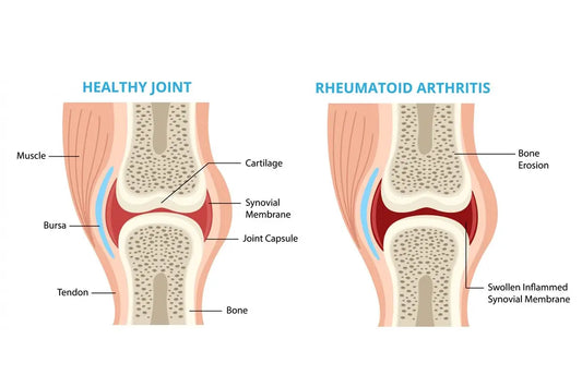 Millets and Rheumatoid Arthritis: The Uncanny Connection