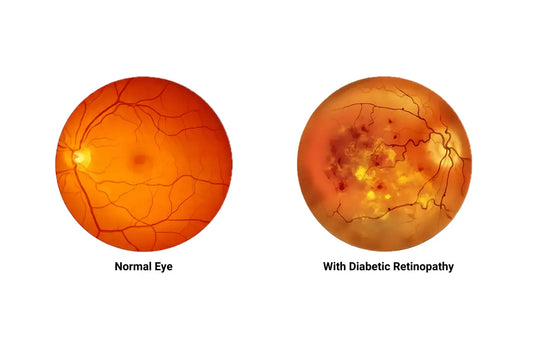 Millets and diabetic retinopathy: Protecting your vision